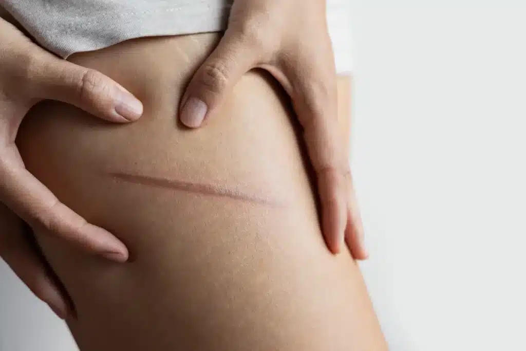 Des cicatrices sur la jambe d'une femme