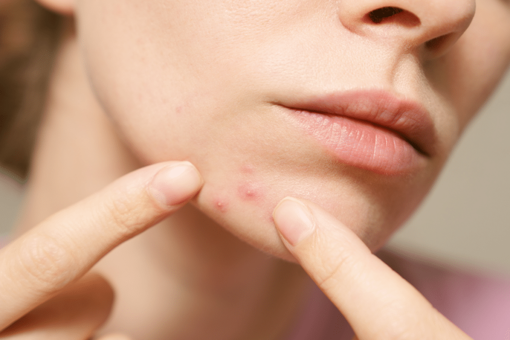 Acné réelle en gros plan sur le visage d'une femme