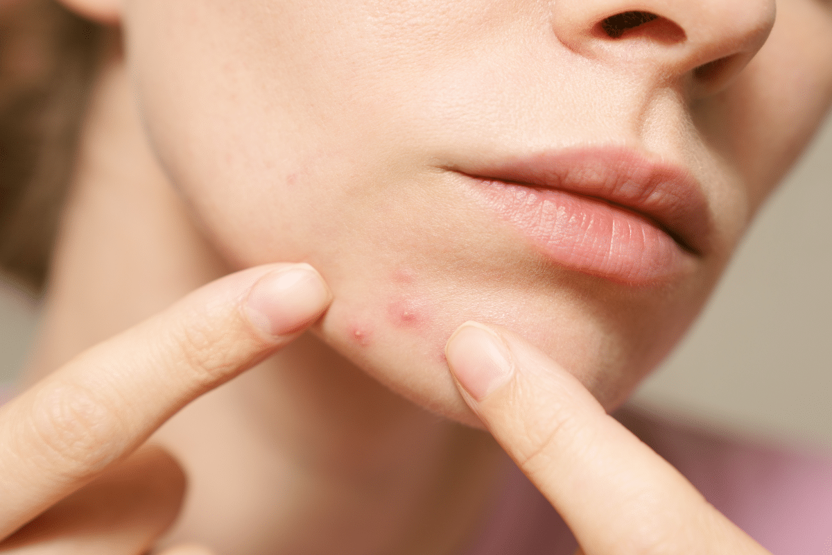 Acné réelle en gros plan sur le visage d'une femme